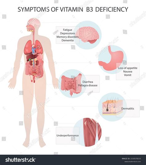 Symptoms Vitamin B3 Deficiency Medical Vector Stock Vector (Royalty ...