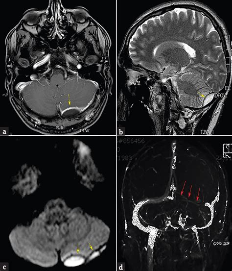 Infratentorial Epidural Abscess Secondary To Furunculosis Case Report