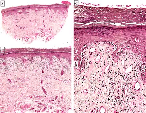 Histological Analysis Of Mm Punchbiopsy Of A Palmar Lesion A