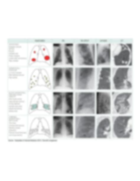 Solution Radiographic Features Of Pulmonary Diseases Studypool