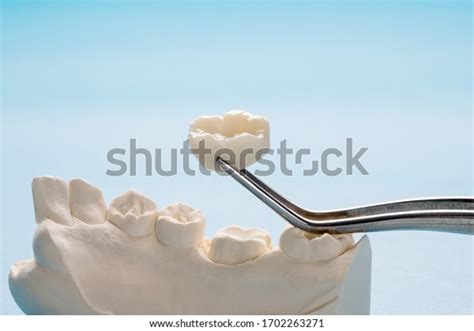 539 Fixed Prosthodontics Stock Photos, Images & Photography | Shutterstock