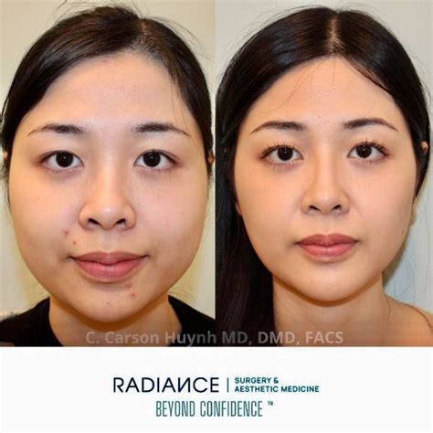 Face Contouring Archives Radiance Surgery Aesthetic Medicine