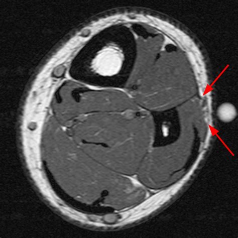 Acromial Stress Fractures After Shoulder Decompression Surgery Radsource