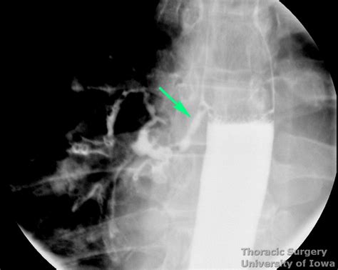 Esophageal Diverticula Midesophageal And Epiphrenic Esophageal