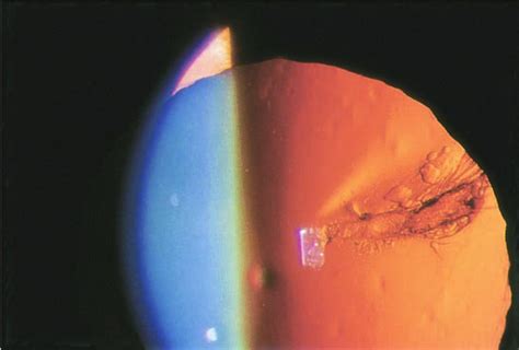 Types Of Cataracts The Cataract Course