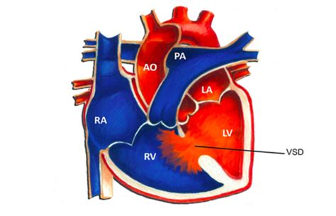 Congenital Heart Disease Flashcards Quizlet