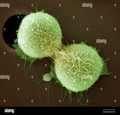 Cervical Cancer Cell Division Coloured Scanning Electron Micrograph