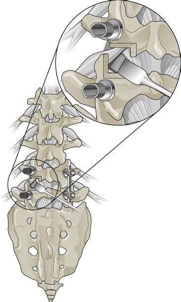 Fusion Surgery And Disc Arthroplasty Anesthesia Key