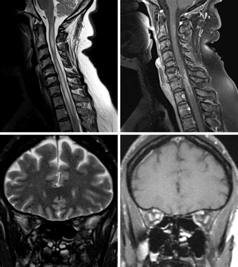 Neuromyelitis Optica (NMO) | The Neurosurgical Atlas, by Aaron Cohen ...