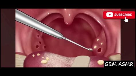 Asmr Cause Of Bad Breath Tonsil Stone Removal Animation Youtube