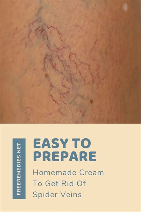 Easy To Prepare Homemade Cream To Get Rid Of Spider Veins In 2020 Spider