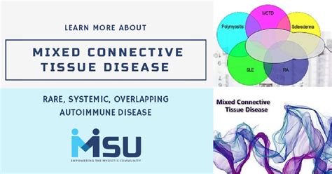 Connective Tissue Disease