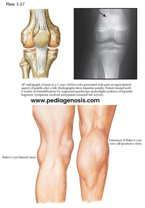 Tulang Kaki Dan Otot Nicholas Oliver