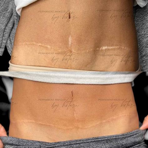 Share 66 Tummy Tuck Scar Tattoo Cover Up Latest In Cdgdbentre