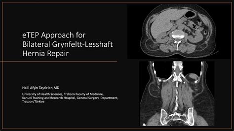 Etep Approach For Bilateral Grynfeltt Lesshaft Hernia Repair Youtube