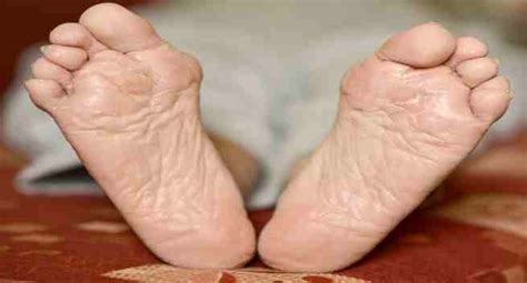 5 Early Warning Signs And Symptoms Of Elephantiasis TheHealthSite