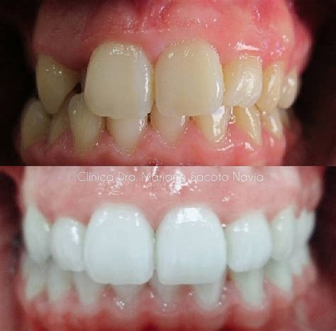 Clínica Mariana Sacoto Invisalign antes y después