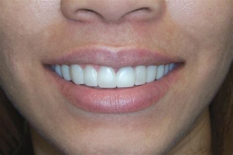 SNAP-ON SMILE - Dental Asensio. Dental Implants Abroad in Spain