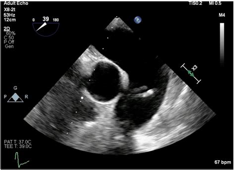 Midesophageal Ascending Aortic Short Axis Tee View Obtained During