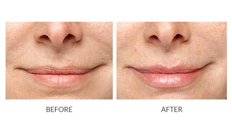 Dermal Fillers Virginia Beach Salt Spa And Wellness Center