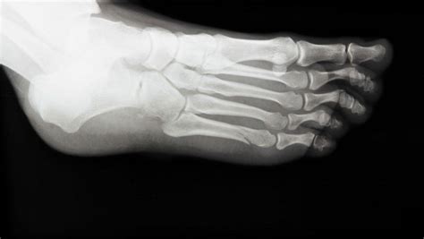 5th Metatarsal Fracture Jones Fracture Dancers Foot Fracture