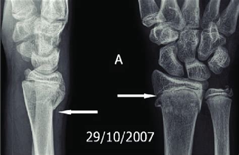 Salter Harris Type Fracture Finger