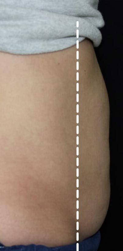 Patient 16382 Body Contouring Before And After Photos Santa Monica