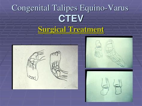 Ppt Congenital Talipes Equino Varus Congenital Clubfoot Powerpoint Presentation Id5730720