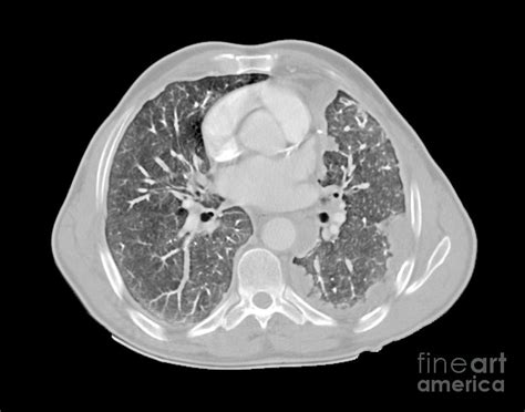 Mesothelioma Lung Cancer Ct Scan By Science Photo Library