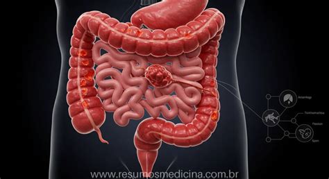 Diarreia Amarela Líquida E Dor Abdominal - Dor na Fossa Ilíaca, Massa e Diarreia: O Que Pode Ser? Guia Diagnóstico ...