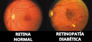 Retinopatía Diabética causas síntomas prevención y tratamientos