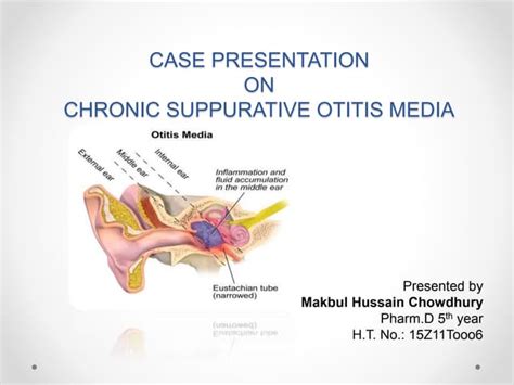 Case Presentation On Chronic Suppurative Otitis Media Ppt