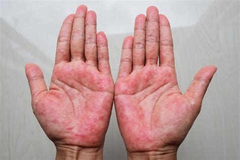 Perawatan Dishidrosis Homecare24