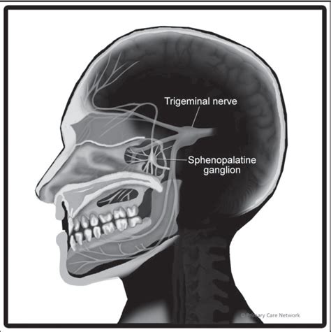 Sphenopalatine Ganglion Block