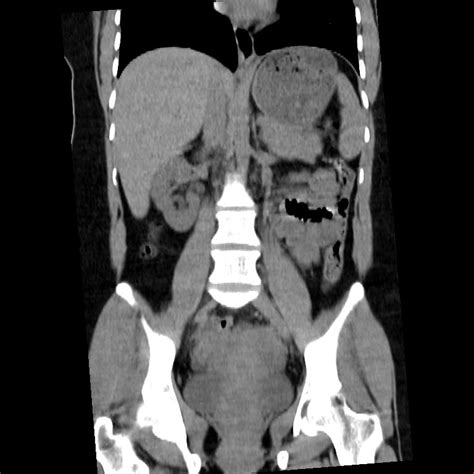 Ureterolithiasis Image
