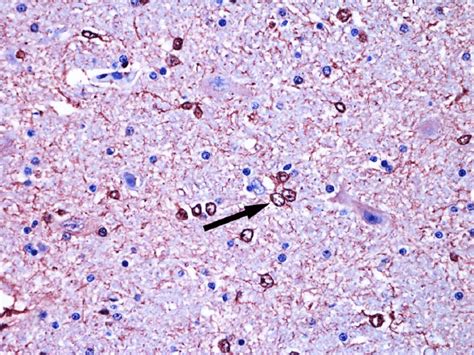 Alzheimer Type Ii Astrocytes Arrow In Anti S100 Immunolabeled