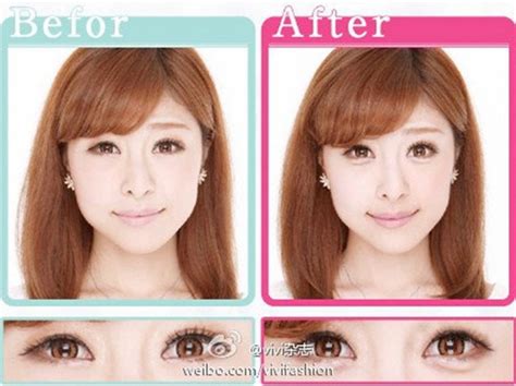 Korean Plastic Surgery Before And After Twins