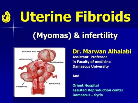 Uterine Fibroids Myomas And Infertility Ppt