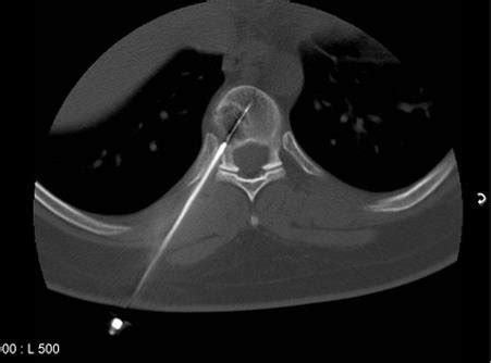 Brachytherapy procedure: a) Placement of external markers on the ...