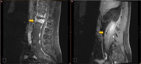 Magnetic Resonance Imaging MRI Of Lumbar Spine Upon Admission Showed