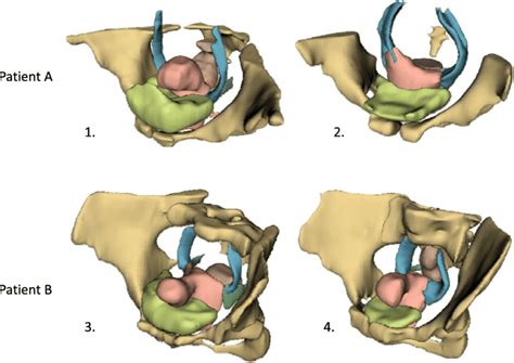 3d Models Of Pelvic Organs Cardinal And Uterosacral Ligaments Patient