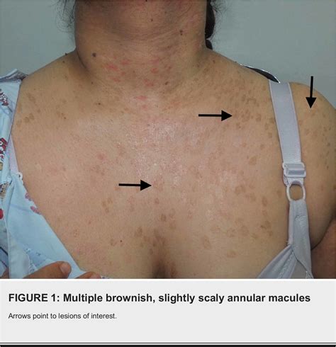 Figure From Epidermodysplasia Verruciformis A Rare Case Report