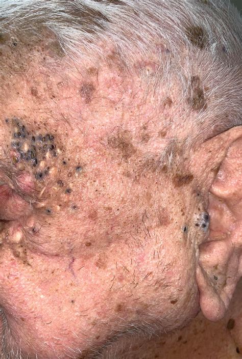 Periorbital And Tragal Cutaneous Lesions Mdedge Dermatology