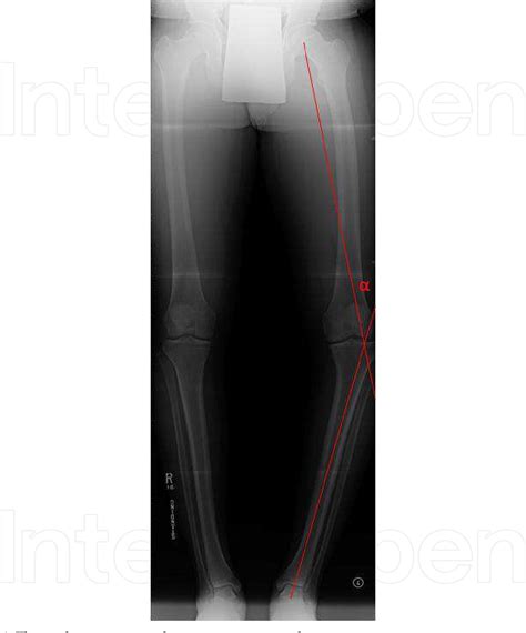 Figure 6 From Role Of High Tibial Osteotomy In Chronic Posterior