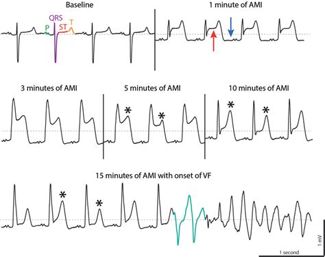 ECG tracings during acute myocardial infarction (AMI) in a porcine ...