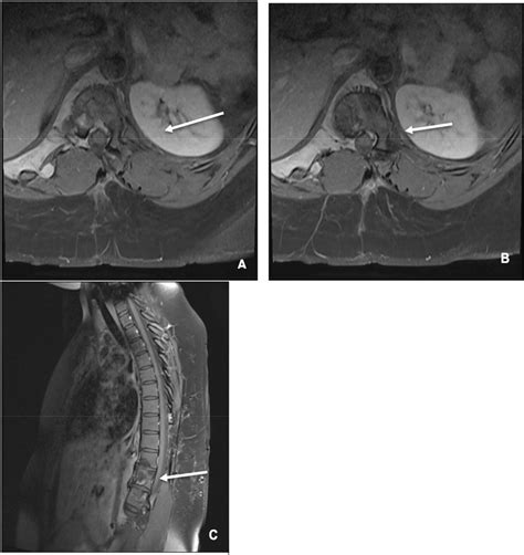 Axial A And B And Sagittal B Contrast Enhanced Fat Suppressed T1