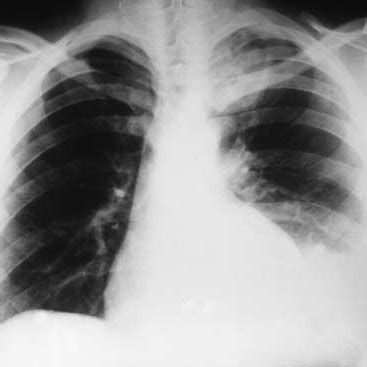 Causes Of Spontaneous True Hemothorax Most Common Causes Coagulation