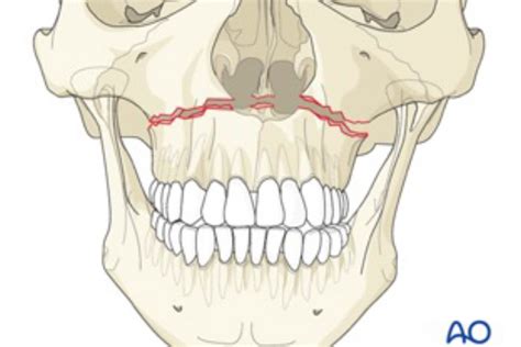 A Dental Student S Guide To Le Fort Fractures Dentistry