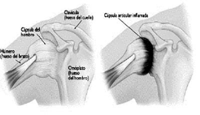Vista de Hombro congelado Diagnóstico y tratamiento RECIAMUC