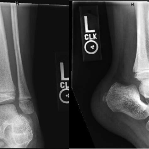 Ap And Lateral Radiographs Of The Left Ankle Reveal Soft Tissue